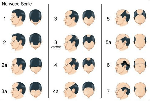 stadia haarverlies proces mannen Noorwood Schaal kaal vertex alopecia androgenetica hormoon dihydroxy-testosteron DHT stress Norwood Scale kale kruin inhammen