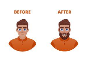Before after voor en na baardtransplantatie baard snortransplantatie snor