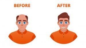 voor en na baardtransplantatie baard snor transplantatie DHI