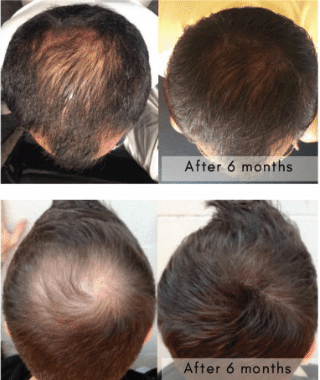 Regenera before after haaruitval behandeling hairloss haargroeiproduct