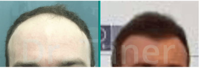 Haartransplantatie resultaat voor en na