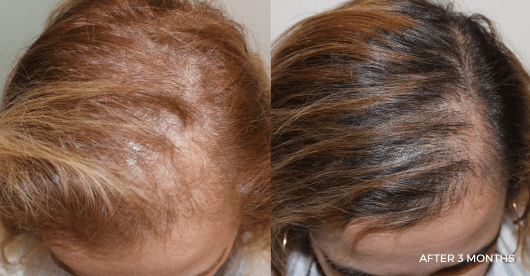 Stamcel behandeling haaruitval Alopecia Androgenetica