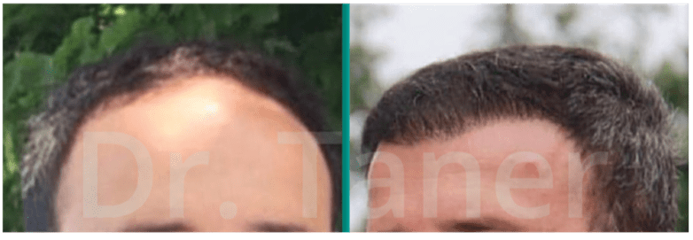 Hair transplant costs | Hair Clinic Wolf