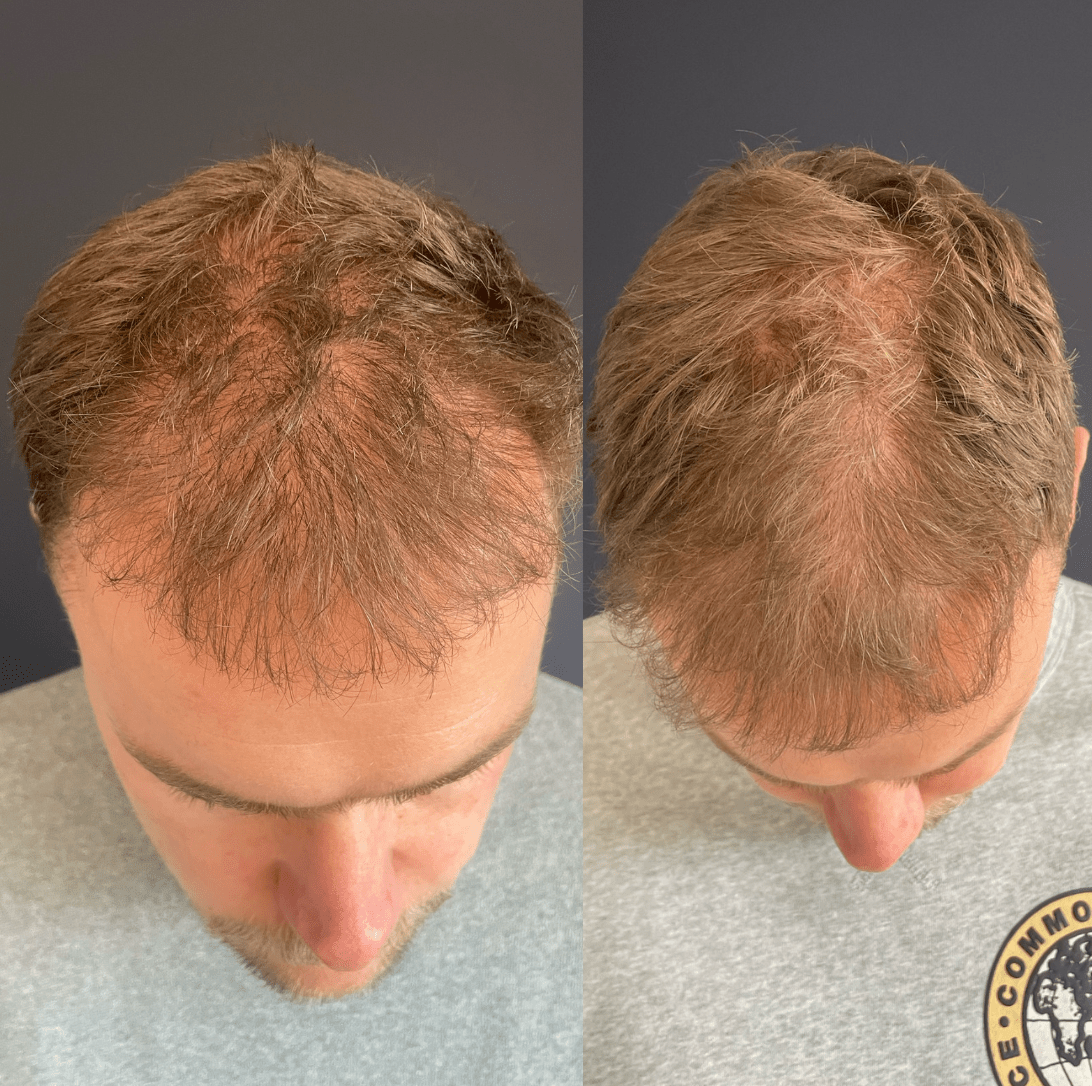 Voor en na hairegen haargroei stimuleren