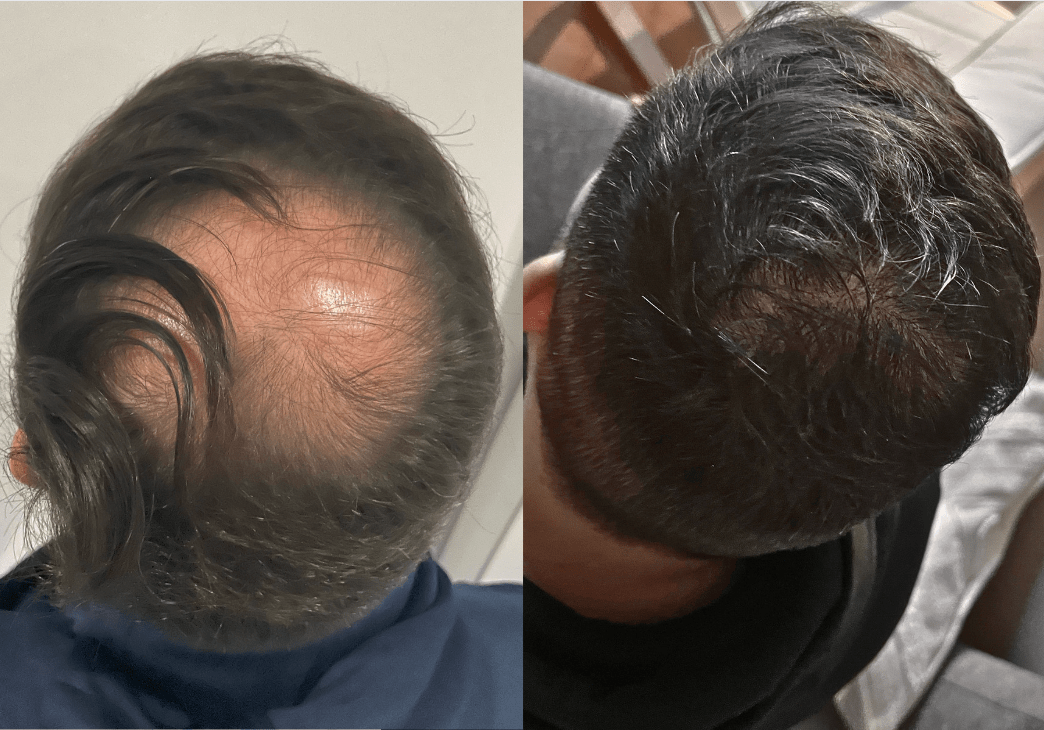 Haartransplantatie kruin voor en na 