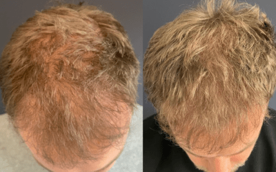 Haargroei stimuleren na haartransplantatie