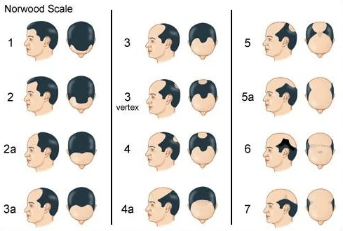 Haarverlies proces bij vrouwen opgedeeld in type I en II