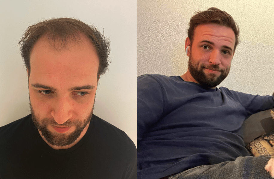 Voor en na foto geslaagde haartransplantatie van de inhammen. 